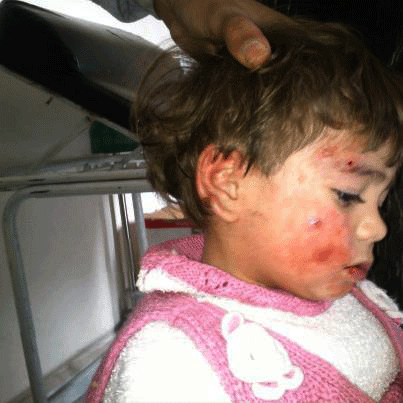 Cutaneous_leishmaniasis