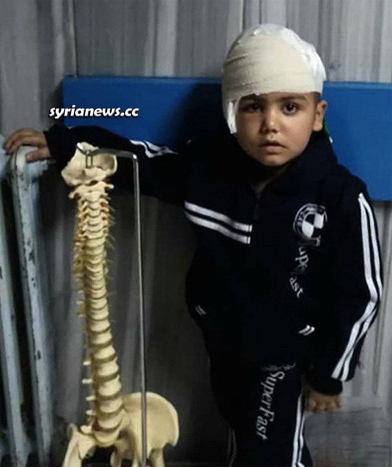 Surgery on Syrian child with Rasmussen's Encephalitis