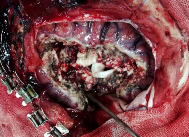 Rasmussen's Encephalitis surgery