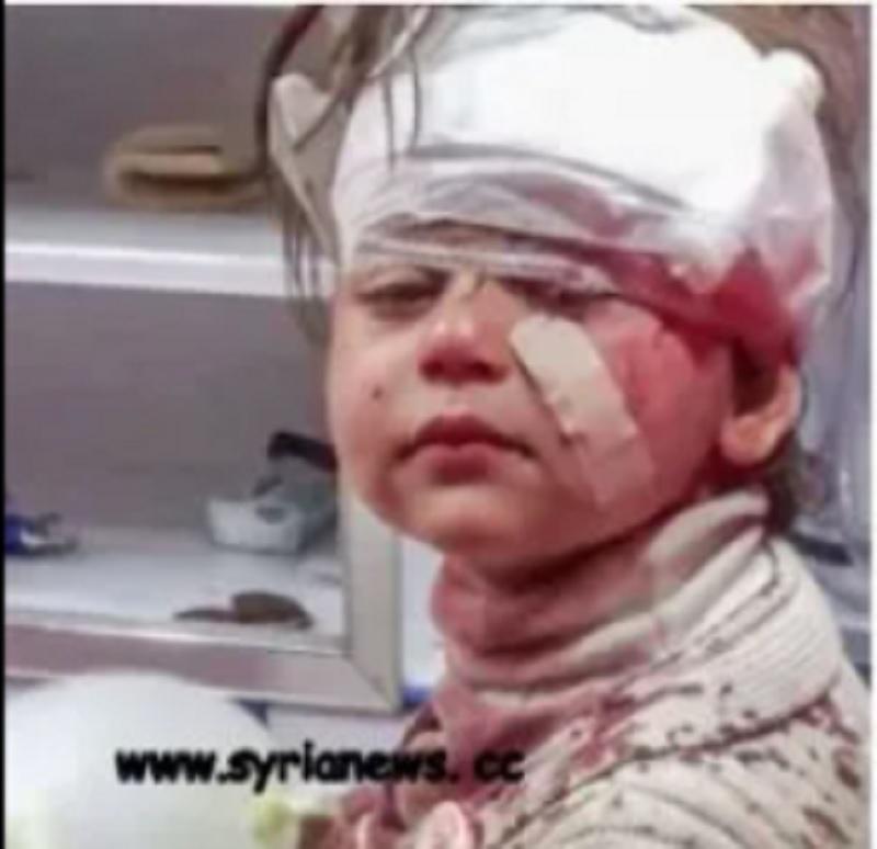 Proper facial & head wound care (Rashidin, Aleppo) by real health professionals.